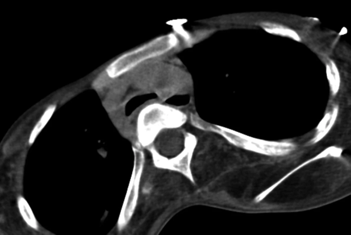 Nativně provedené CT hrudníku, snímky v referenční úrovni oblouku aorty – kontrolní v dubnu 2008