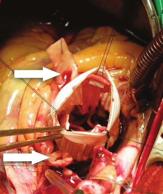 Foto z operace během reimplantace aortální chlopně. Aortální chlopeň a její 3 komisury jsou již upevněny uvnitř cévní protézy pomocí 3 stehů. Šipky označují vystřižené terčíky odstupů věnčitých tepen.