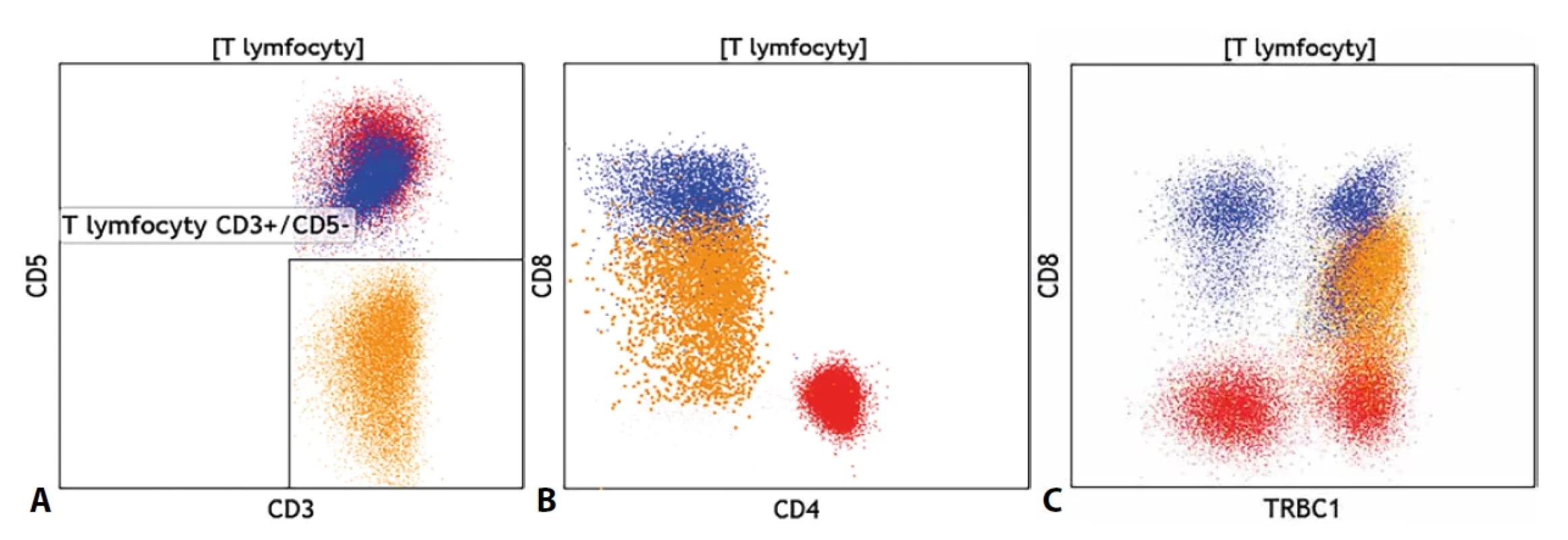 (A) Nález fenotypově atypické klonální populace T lymfocytů se ztrátou exprese znaku CD5 (oranžově), (B) se slabou expresí znaku CD8 a (C) s výlučnou expresí znaku TRBC1 na celé populaci oproti normální distribuci tohoto znaku na fenotypově normálních CD4+ pomocných T lymfocytech (červeně) a CD8+ cytotoxických T lymfocytech (modře).