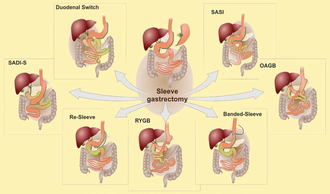 Možnosti konverze sleeve gastrectomy na jiné bariatrické metody    Fig. 5: Options for convertion of sleeve gastrectomy to other bariatric methods