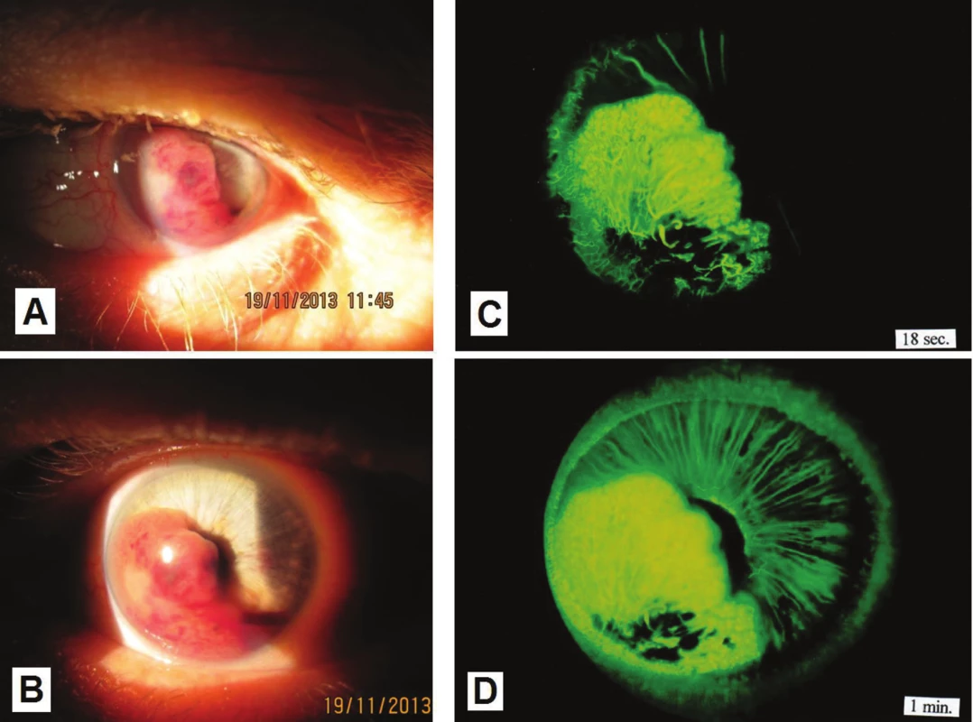 Makrofoto predného segmentu s melanómom prerastajúcim do prednej komory (A, B); fluoresceínová angiografia toho istého pacienta (C, D) – tumor je pred plánovaným ožiarením na lineárnom urýchľovači. Ďakujeme za fotografie C a D autorom: primárovi MUDr. Streicherovi a MUDr. Špirkovej z Bojníc