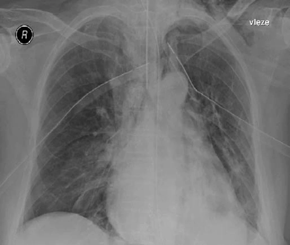 RTG plic po zavedení hrudních drénů.
Fig. 3. Chest X-ray of the lungs after the introduction of chest tubes.