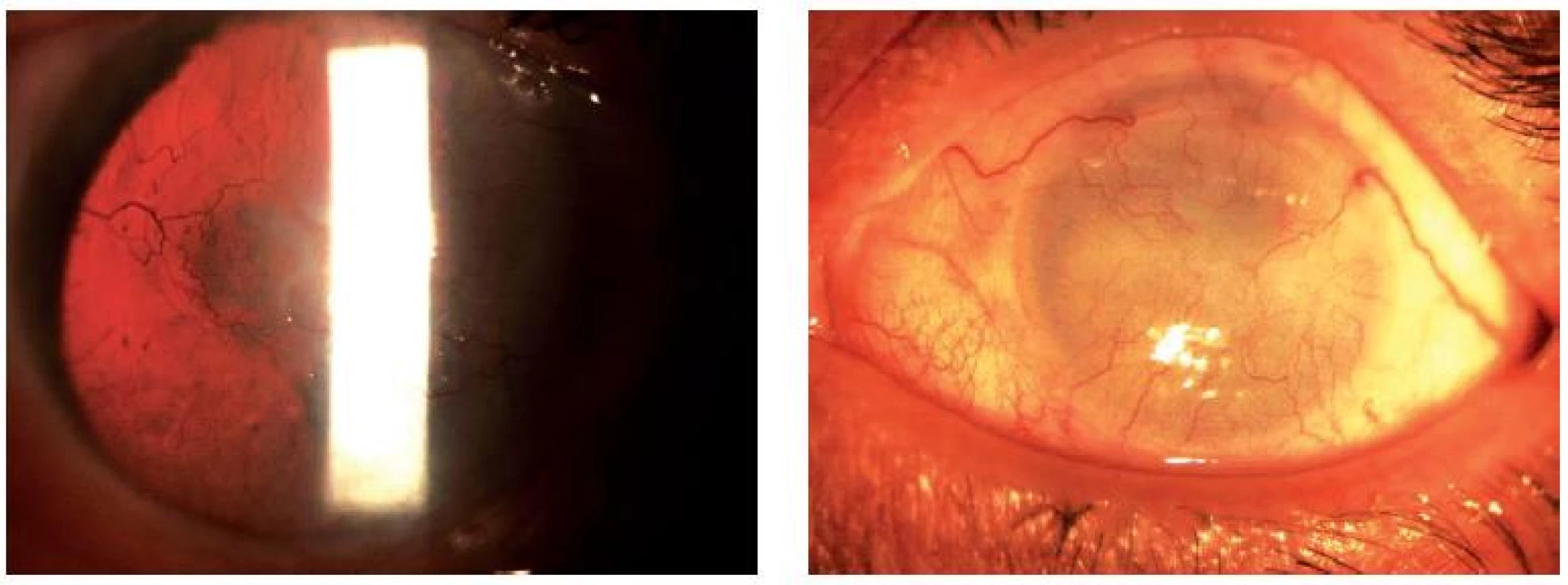 Pacient I-1: pravé (A) a levé oko (B), aniridie, vysoký stupeň AAK.