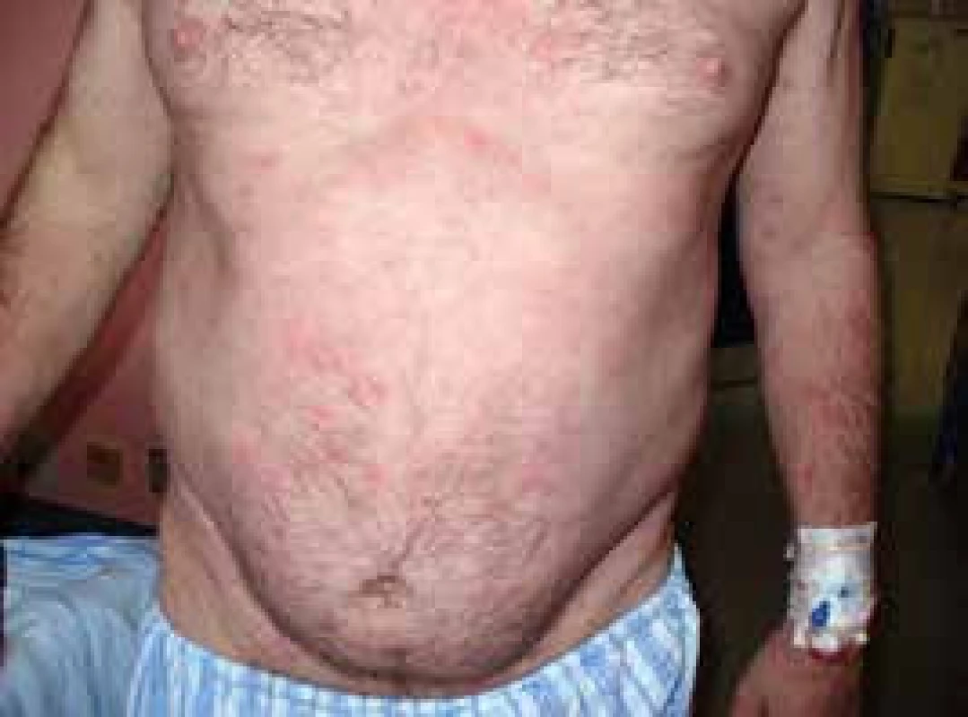 Snímek pvního pacienta s velkými kopřivkovými morfami před léčbou anakinrou