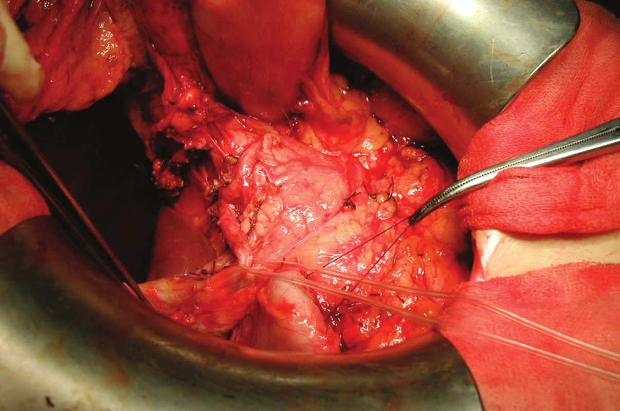 Operační nález v průběhu D2 lymfadenektomie: na hadičce je zavěšena a. hepatica communis, závěsné stehy odtahují uzavřený pahýl duodena