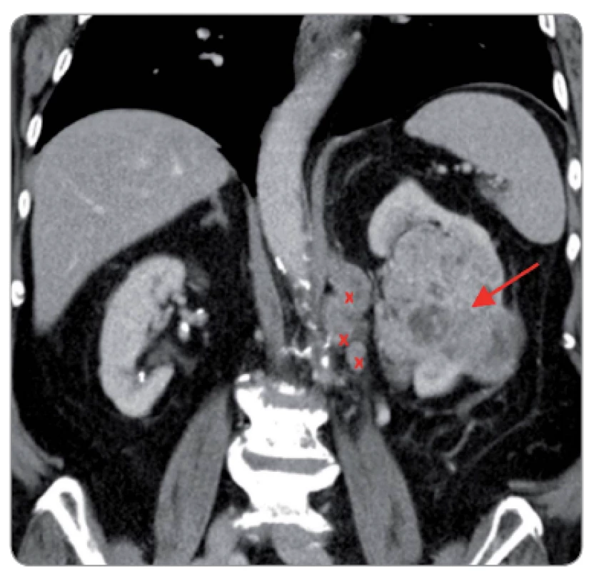 CT obraz u 72-ročného muža s pokročilým RCC ľavej obličky (označené červenou šípkou) a aj s  metastázami v regionálnych lymfatických uzlin (označené červenými krížikmi); s pacientom konzultovaná cytoreduktívna nefrektómia, ktorú odmietol a preto realizovaná systémová terapia; exitus na generalizáciu procesu 9 mesiacov po stanovení diagnózy [18,19].