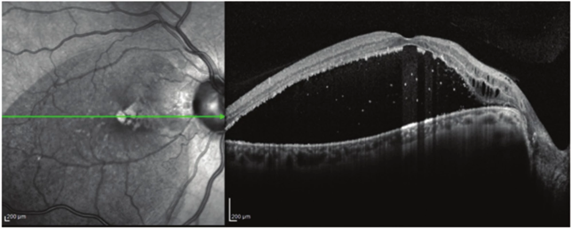 Pacient č. 6
Lineární horizontální transfoveolární OCT sken OP před PPV, makulární retinoschíza vnitřní a zevní sítnicové vrstvy se subretinální tekutinou