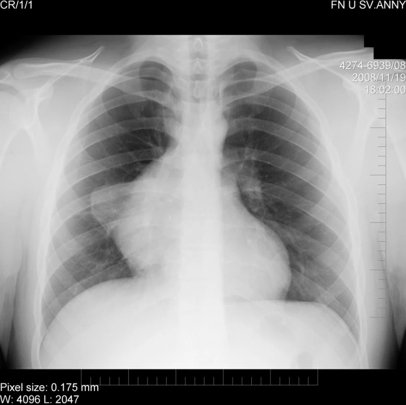 Původní rentgenogram s patologickým zastíněním mediastina
Fig. 1. The original chest X-ray with the patologic mediastinum