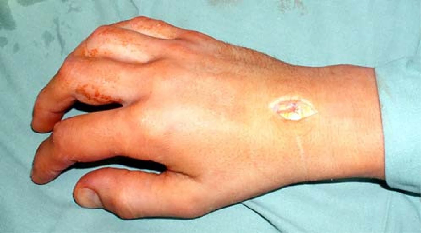 2,5–3cm dlouhá operační rána po preparaci podkoží