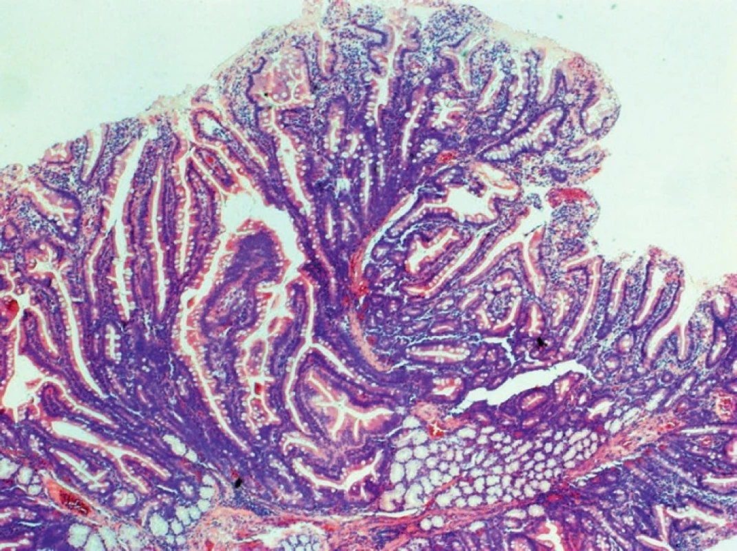 Tubulovillous adenoma of the duodenum, HE, 40x