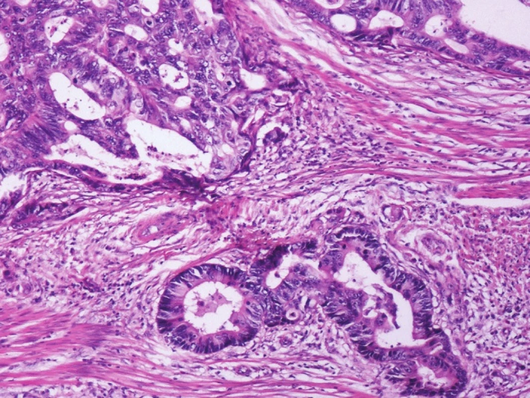 Kazuistika 1 – adenokarcinom tlustého střeva s tubulárním uspořádáním (HE, 40x)
Fig. 1: Case 1 – colonic adenocarcinoma with tubular arrangement (HE, 40x)