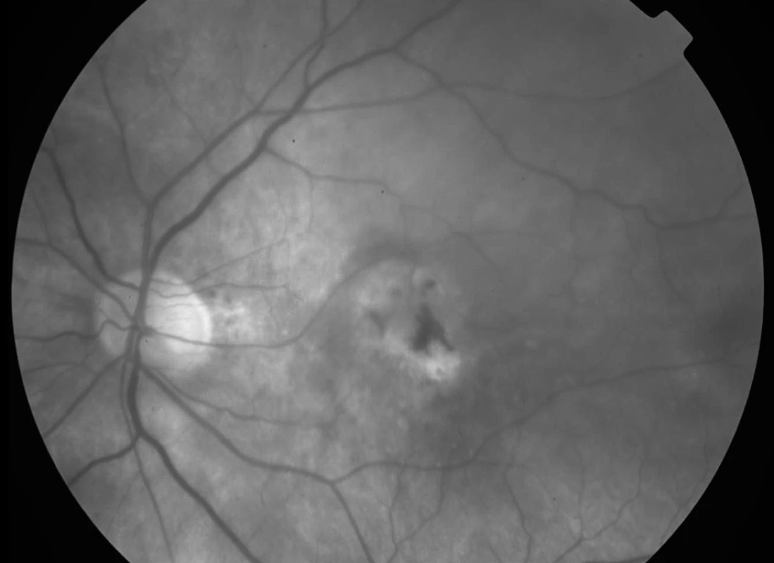 Bezčervený snímek fundu levého oka pacienta 18 měsíců po skončení studie ANCHOR