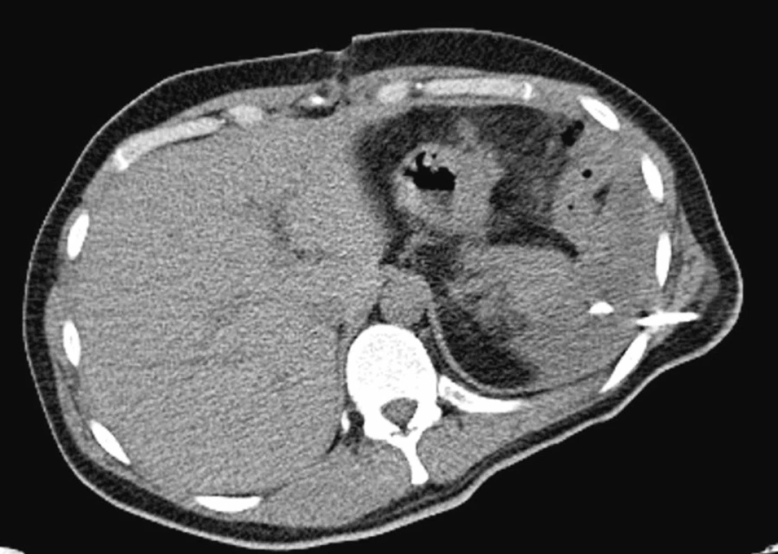 CT vyšetření – stav po splenektomii, drenáž subfrenického abscesu. Pankreatický vývod nepoškozen
Fig. 3. CT examination – Post-splenectomy condition, drainage of the subphrenic absces. The pancreatic duct is intact
