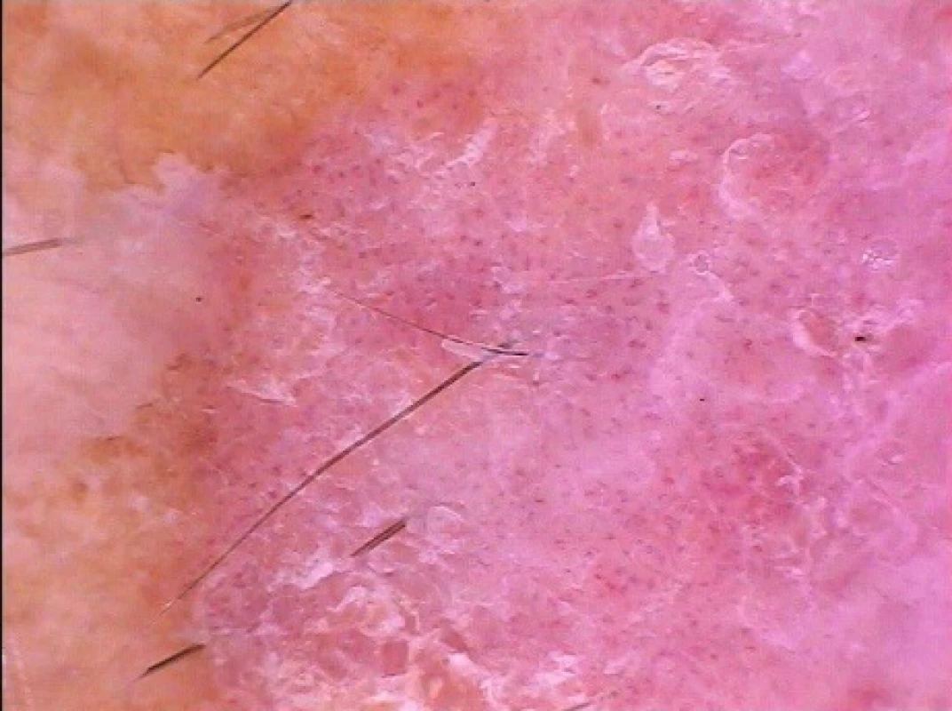 Carcinoma in situ typu morbus Bowen