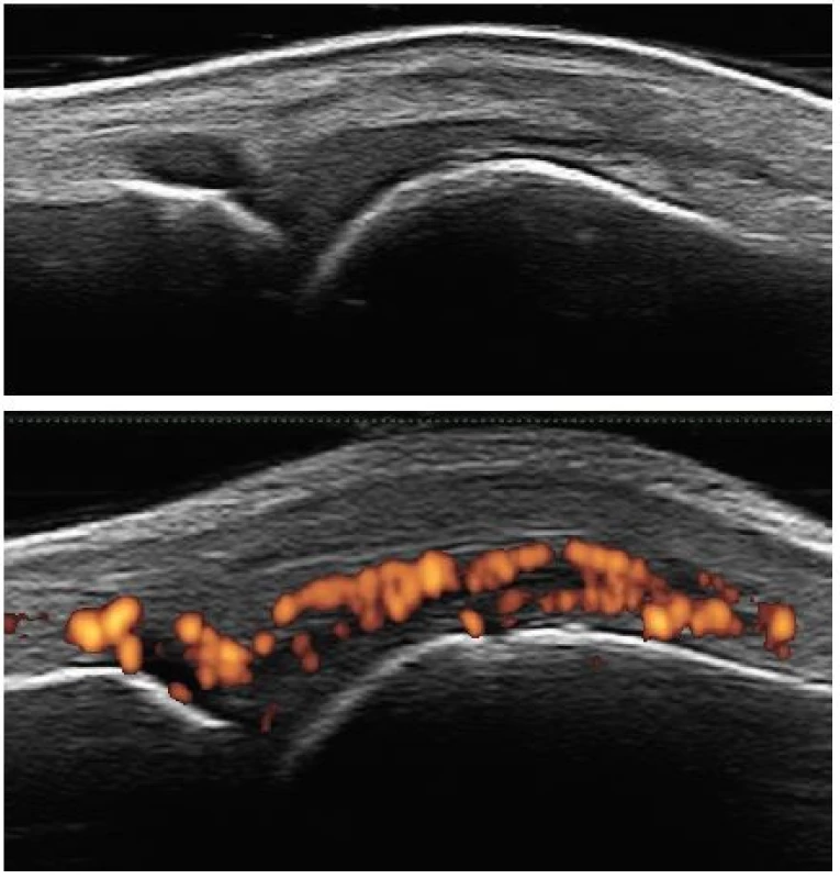 Aktivní artritida metakarpofalangeálního skloubení
Nahoře: nález hypetrofické synovie v Grey Scale; dole: pozitivní