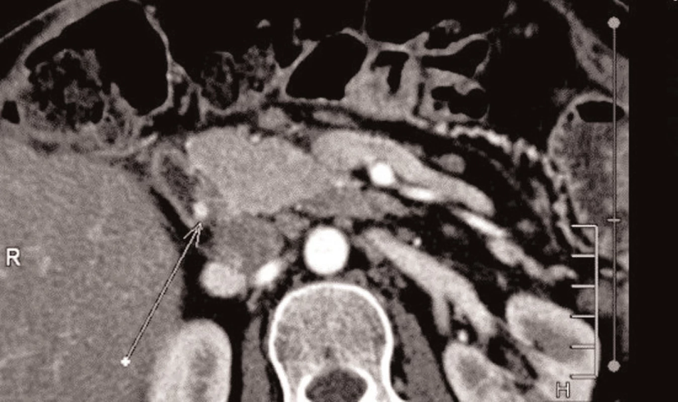 Pooperační CT s reziduální lézí v duodenu
Fig. 4: Postoperative CT scan with a residual duodenal lesion