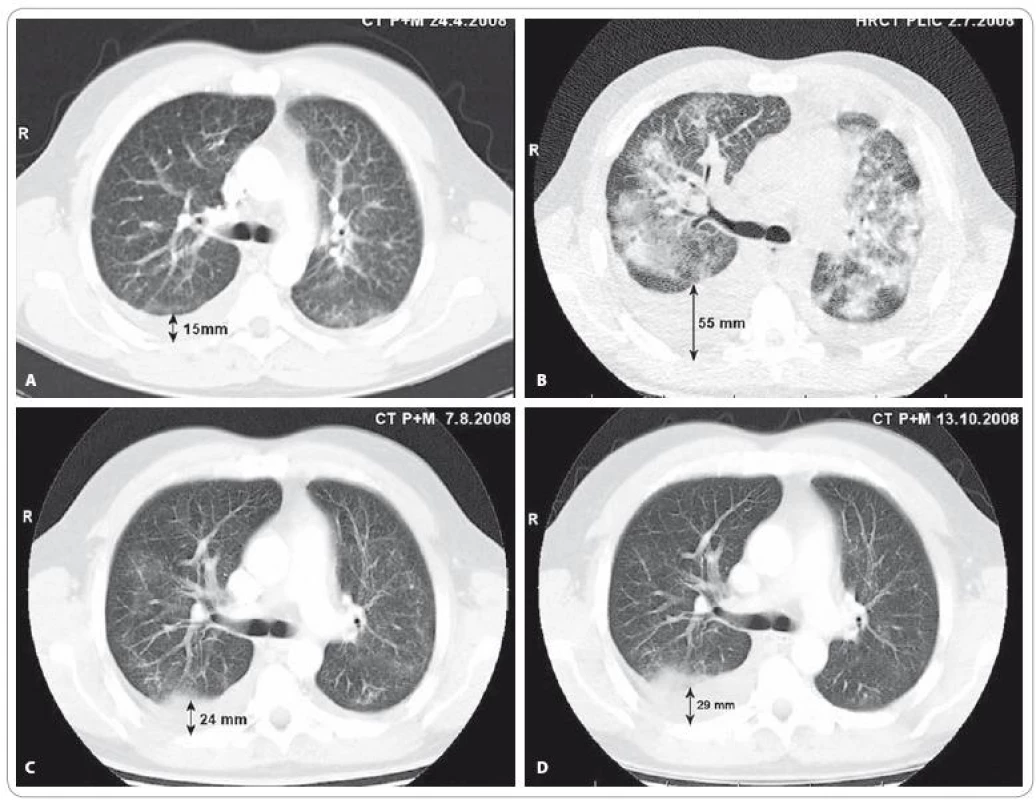 A) CT vyšetření plic a mediastina v době před stanovením diagnózy bronchioloalveolárního karcinomu. V popisu CT a předchozího HRCT zhodnoceno jako: „Oboustranný intersticiální plicní proces charakteru fi brotizující alveolitidy s mikro- až makronodulací.“ (Vyšetření provedeno mimo MOÚ). B) HRCT vyšetření plic provedené v době progrese onemocnění po 2. sérii iniciální chemoterapie v režimu karboplatina/paklitaxel: „V plicním parenchymu oboustranně poměrně symetrická, výrazná alveolární infiltrace s max. perihilózně, spíše vynechávající periferní peripleurální partie plic, s patrným air-bronchogramem bilat. Ve srovnání s dokumentací z 24/4/08 nález ve výrazné progresi.“ V této době je pacient v celkově velmi špatném stavu (PS 3), manifestovaném zejména klidovou dušností (saturace SpO&lt;sub&gt;2&lt;/sub&gt; 74 %, měřeno puzlním oxymetrem, bez oxygenoterapie) a intermitentním dávivým kašlem s bronchorrheou. C) CT vyšetření plic a mediastina provedené 1 měsíc od zahájení cílené léčby inhibitorem tyrozinkinázové aktivity EGFR – erlotinibem: „Prokázána výrazná regrese velikosti i rozsahu měkkých převážně alveolarních infi ltratů v obou plicních křídlech a regrese pleurálních výpotků.“ D) CT vyšetření plic a mediastina provedené 3 měsíce od zahájení léčby erlotinibem: „Další regrese nízce denzních infiltrátů v plicním parenchymu bilat. Fluidothorax vpravo lehce výraznější, vlevo regrese ad integrum. Uzliny v mediastinu již stacionární. Karcinomatóza skeletu stacionární.“
Vyšetření provedli: MUDr. Petr Opletal, MUDr. Renata Belánová, MUDr. Michal Standara.