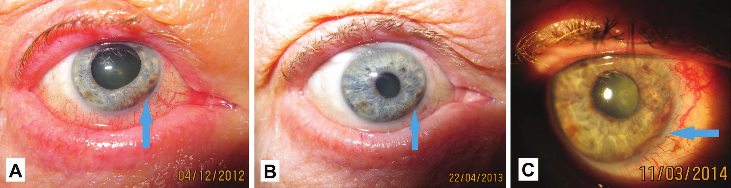 Makrofoto predného segmentu oka u pacienta v r. 2012 (A), v r. 2013 (B) a v r. 2014 (C)