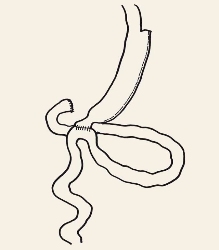 Duodenoileální anastomóza s rukávovou resekcí žaludku.
Fig. 5. Single anastomosis duodeno-ileal bypass with sleeve gastrectomy.