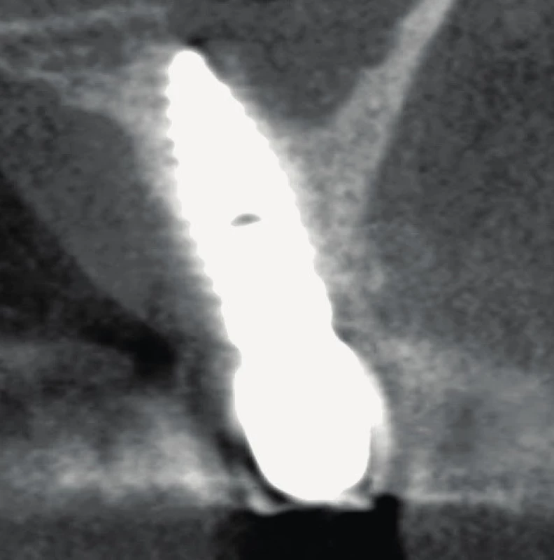 „Implant in palatal curvature“. Orientace jako na obr. 3.