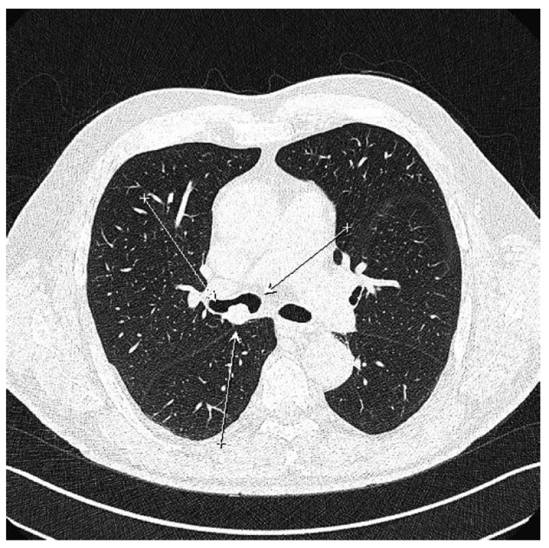 CT plic před operací
Fig. 6: Lung CT before the IRE procedure