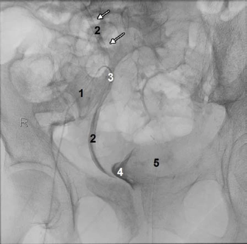 Ilikoureterální píštěl. 1) Katétr v tepně (zevní ilická arterie vpravo), 2) močovod, 
3) ilikoureterální píštěl, 4) močový měchýř, 5) močový katétr
Fig. 3 Ilicoureteral fistula. 1) Catheter in an artery (right external iliac artery), 2) ureter, 
3) ilicoureteral fistula, 4) urine bladder, 5) urinary catheter