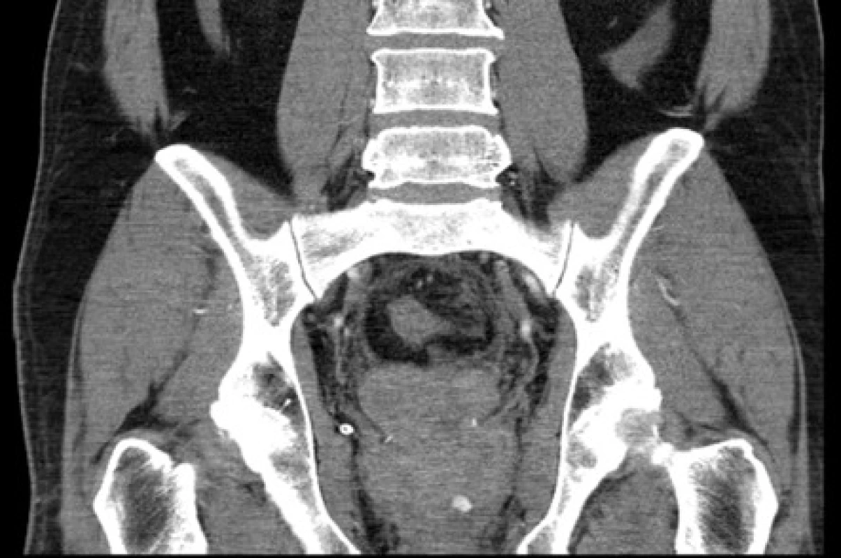 &lt;i&gt;CT – arteriální leak vlevo po prostatektomii – frontální řez&lt;/i&gt;
Fig. 2. &lt;i&gt;CT scan: arterial leak on left side after prostatectomy – coronal view&lt;/i&gt;