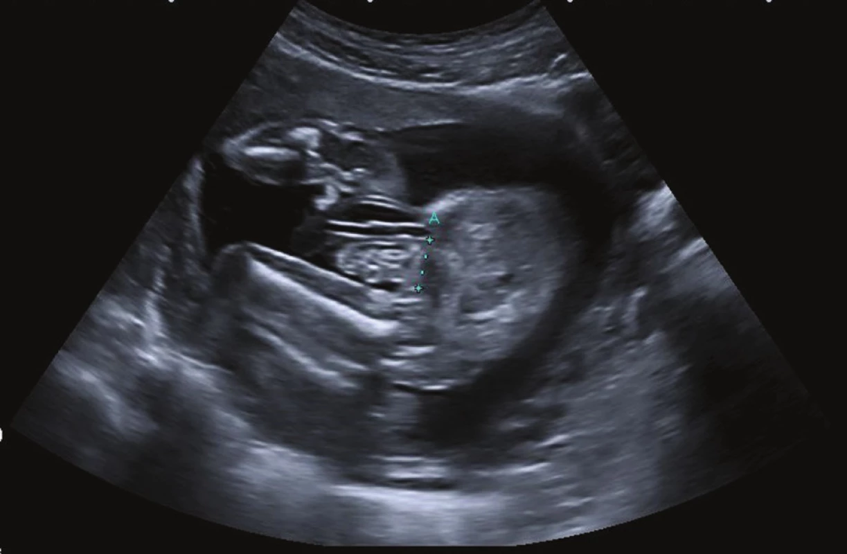 Prenatální ultrazvukové vyšetření u gastroschízy
Fig. 2: Prenatal ultrasound scan of gastroschisis