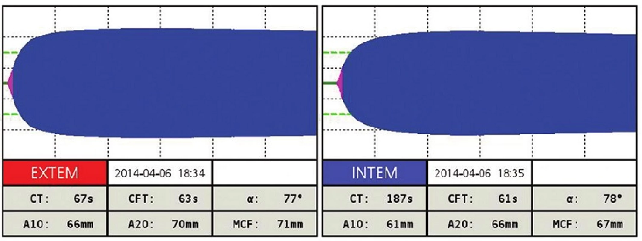 ROTEM po terapii pri INR 1,8
Všetky parametre EXTEM a INTEM sú v norme.
Fig. 3: ROTEM after the treatment with INR 1.8
All parameters of EXTEM and INTEM are normal.