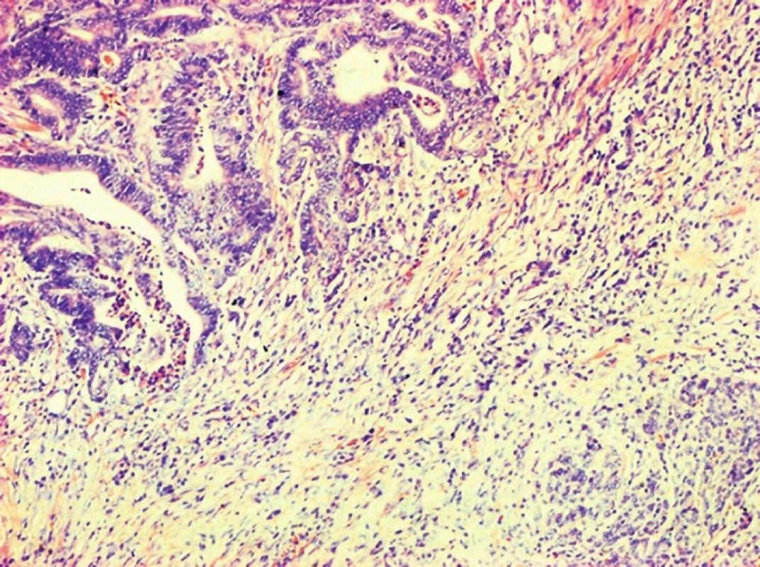 Adenocarcinoma of the ampullary region with invasion to the pancreas, HE, 100x