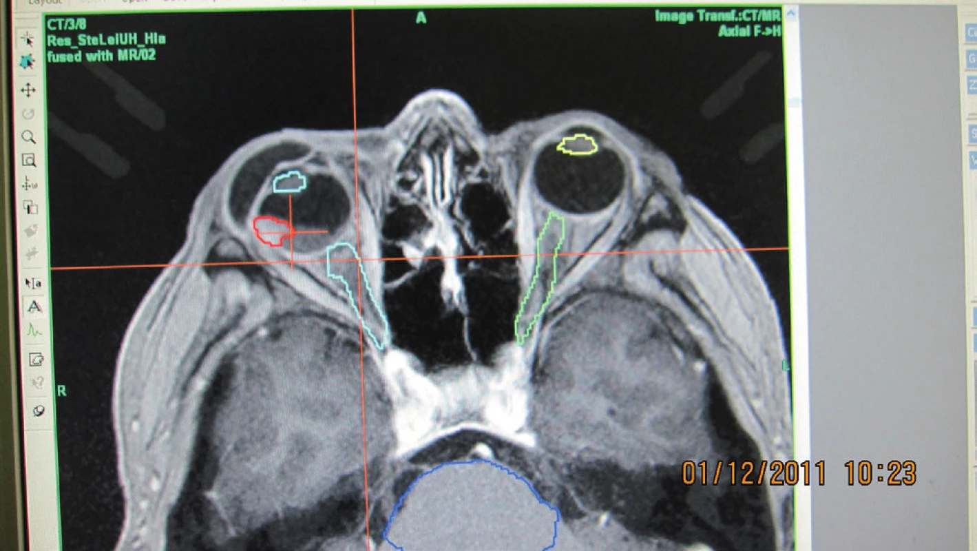 Označenie nádorového intrabulbárneho ložiska (červená farba) a rizikových štruktúr (šošovky, zrakové nervy, kmeň) pred vytvorením stereotaktického rádiochirurgického plánu pre pacienta s malígnym melanómom choroidey