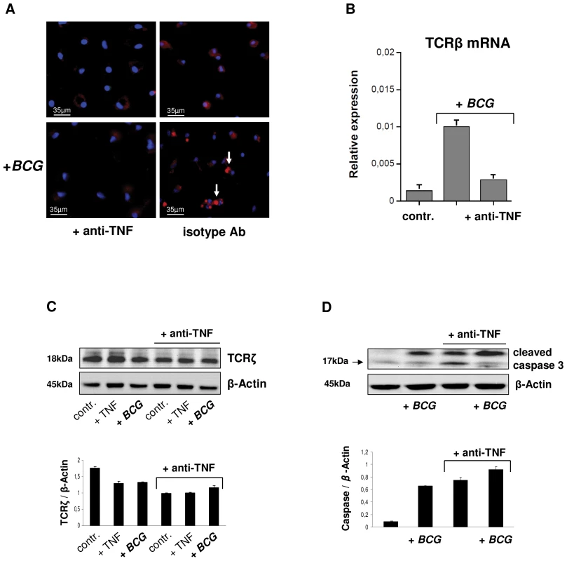 TNF blockade inhibits expression of the macrophage-TCRαβ.