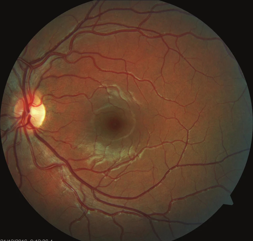Barevný fotografický snímek fundu levého oka: na očním pozadí fyziologický nález