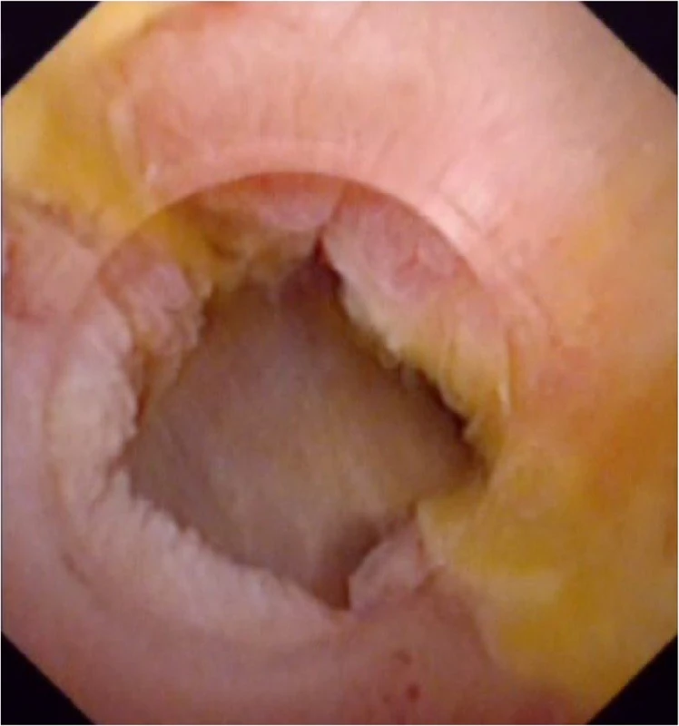 supporting stent has been removed after more than 6 months, and subsequent choledochoscopy shows the mucosa of the anastomotic stenosis repaired normally without edema and scar formation. There is no stricture, relative stricture, floc, sludge, or residual stone in extrahepatic bile duct