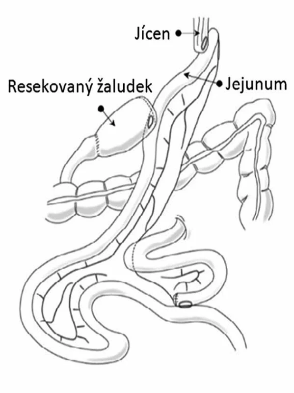 Proximální gastrektomie s rekonstrukcí dvojitého traktu    Fig. 3: Proximal gastrectomy with double tract reconstruction
