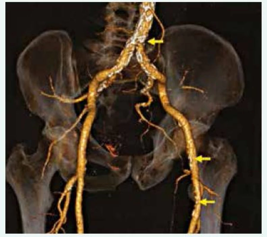 CT angiografie (3D rekonstrukce) distální aorty, pánevního řečiště a obou femorálních tepen; patrné mnohočetné aterosklerotické postižení (šipky). 