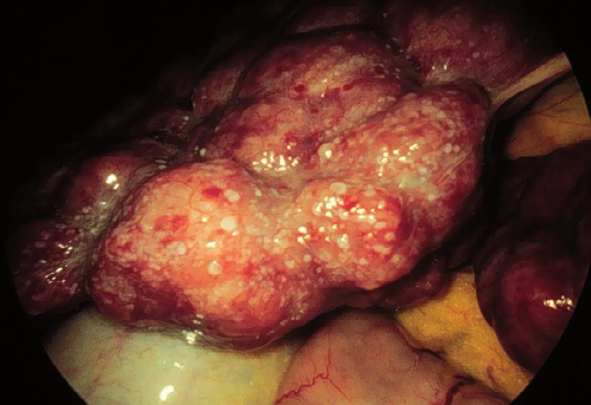 Autoimunitní hepatitis – makroskopický obraz.