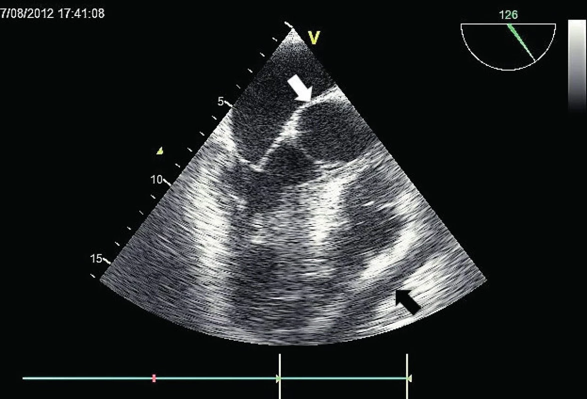 Dilatace kořene aorty a perikardiální výpotek
Dilatovaný kořen aorty (bílá šipka) a perikardiální výpotek (černá šipka) v TEE zobrazení.
