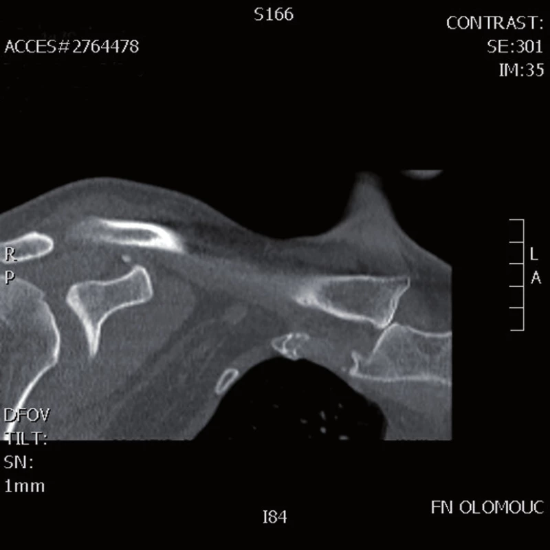 Předozadní rekonstrukce CT vyšetření, zachycena kraniální dislokace mediálního konce klíční kosti