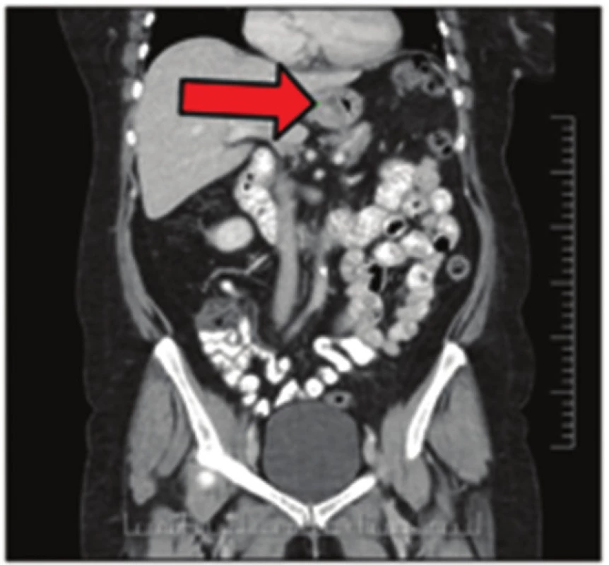 GIST žaludku na CT snímku
Fig. 2: Gastric GIST on CT scan