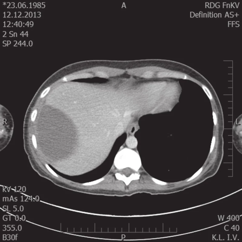 Kontrolní CT vyšetření za 7 týdnů, regrese hematomu
Fig. 3. Follow-up examination 7 weeks after injury, regression of hematoma