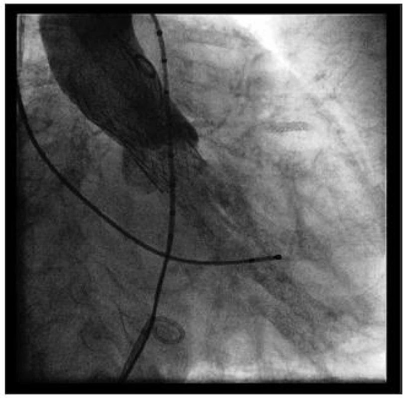 Stav po implantaci chlopně – zaváděcí pouzdro je odstraněno, nástřik kontrastní látky do bulbu aorty prokazuje optimální pozici chlopně a nepřítomnost aortální regurgitace