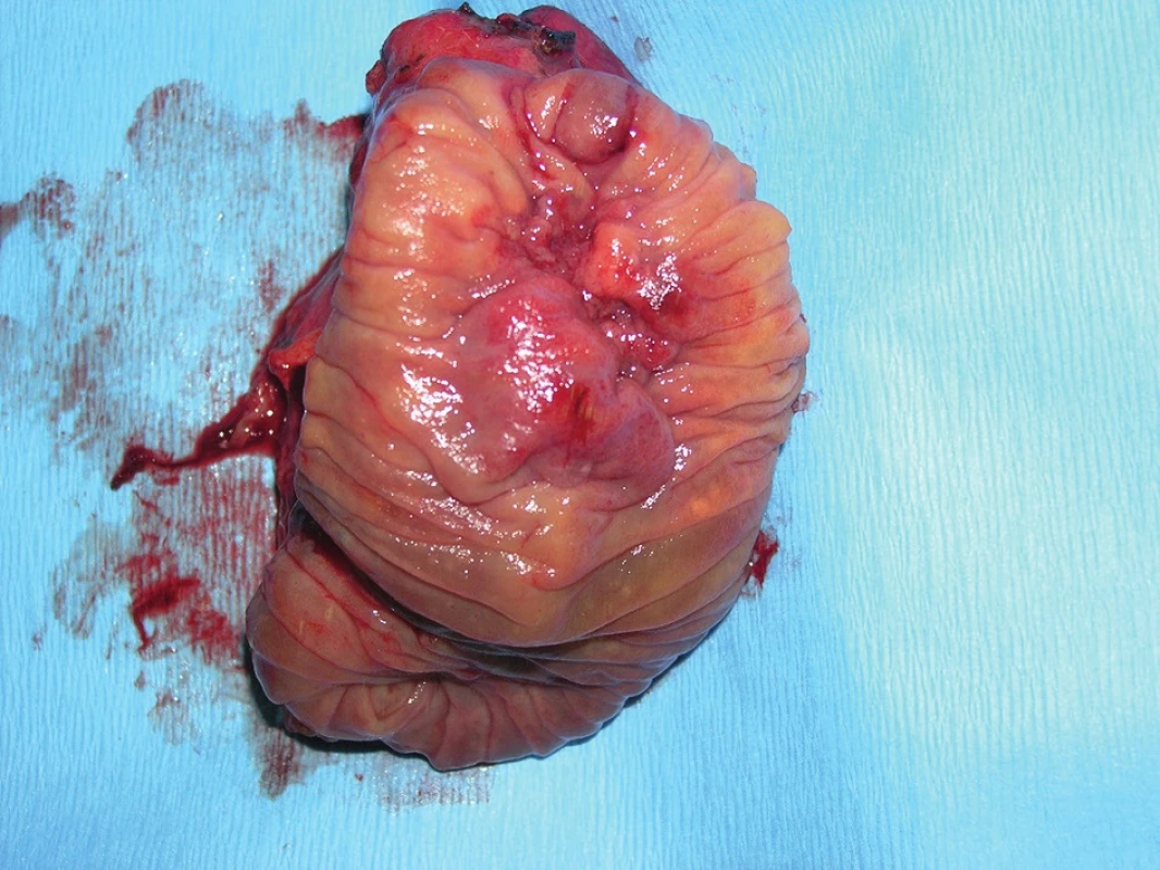 Intraampullary adenocarcinoma of the papilla of Vater – resected specimen