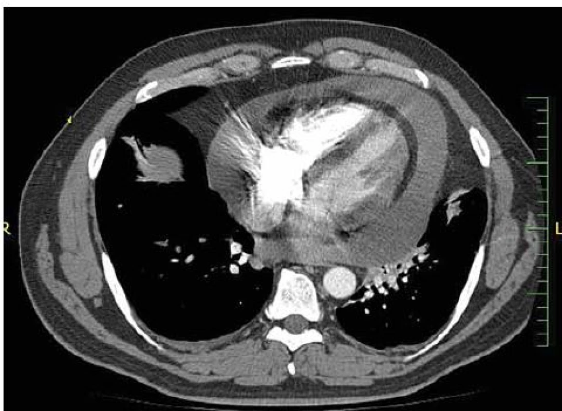 CT AG plicnice (03/2013) – perikardiální výpotek.