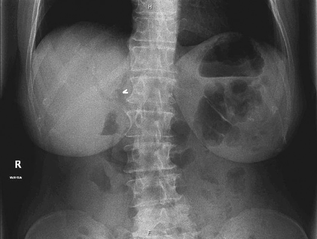 Prostý snímek břicha vstoje v předozadní projekci: nejsou známky pneumoperitonea, ale v pravém horním kvadrantu lze zřetelně pozorovat plynovou náplň ve žlučových cestách (viz šipka). Samotný žlučový konkrement není spolehlivě viditelný – obsahuje jen málo kalcifikací a je v sumaci s bederní páteří
Fig. 1. Native, A-P abdominal view: no signs of pneumoperitoneum, however, in the right upper quadrant, gas filling in the bile ducts can be detected (arrow). Agallbladder concrement is not detectable – it contains only a few calcifications and overlaps with the lumbar spine