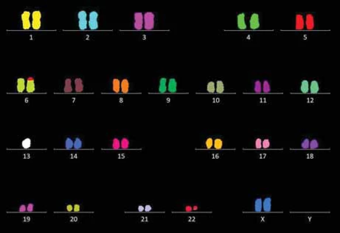 Výsledný karyotyp na základě M-FISH (24XCyte, Metasystems): 45,XX, t(6;22)(p25;q11.2),-13.
