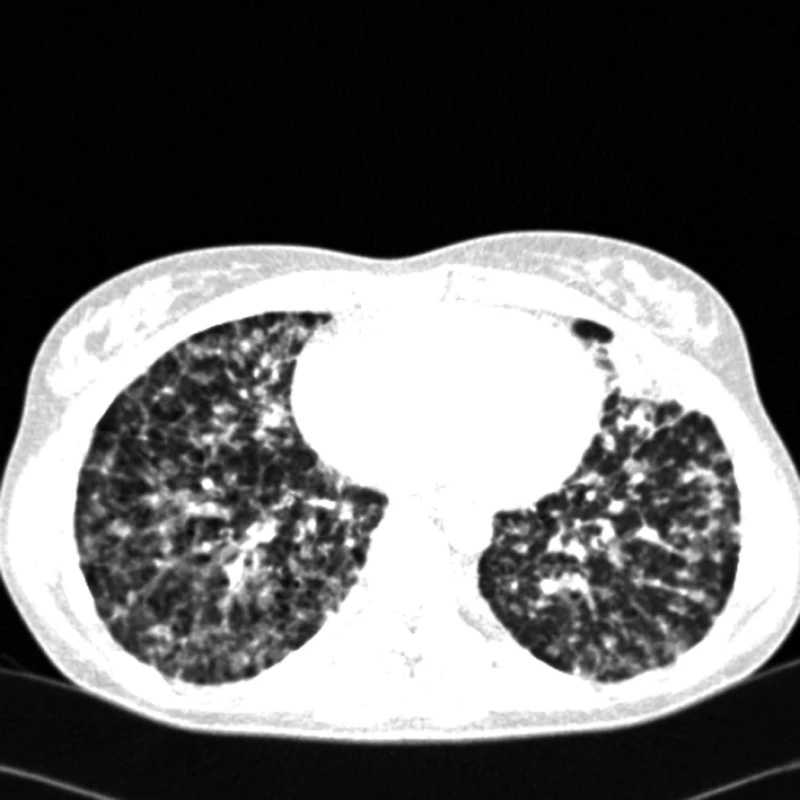 CT – mnohočetné plicní postižení u plicního epitelioidního hemangioendoteliomu.