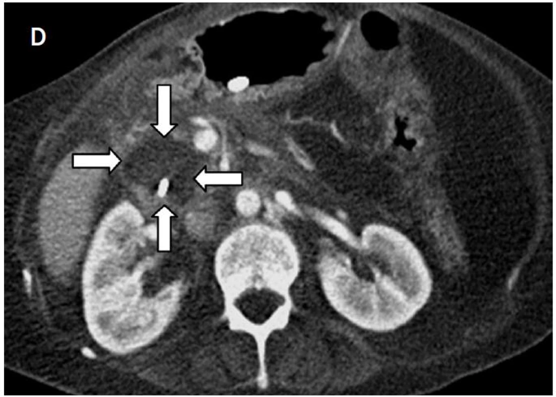 A – na axiálních CT skenech je patrný karcinom hlavy pankreatu před IRE (šipky); B – uložení čtyř elektrod v oblasti nádoru; C – rozsah nekrózy bezprostředně po IRE; D – při kontrole za 1 měsíc je patrné ložisko nekrózy v místě původního nádoru a drén zavedený via PTD do žlučových cest (šipky)