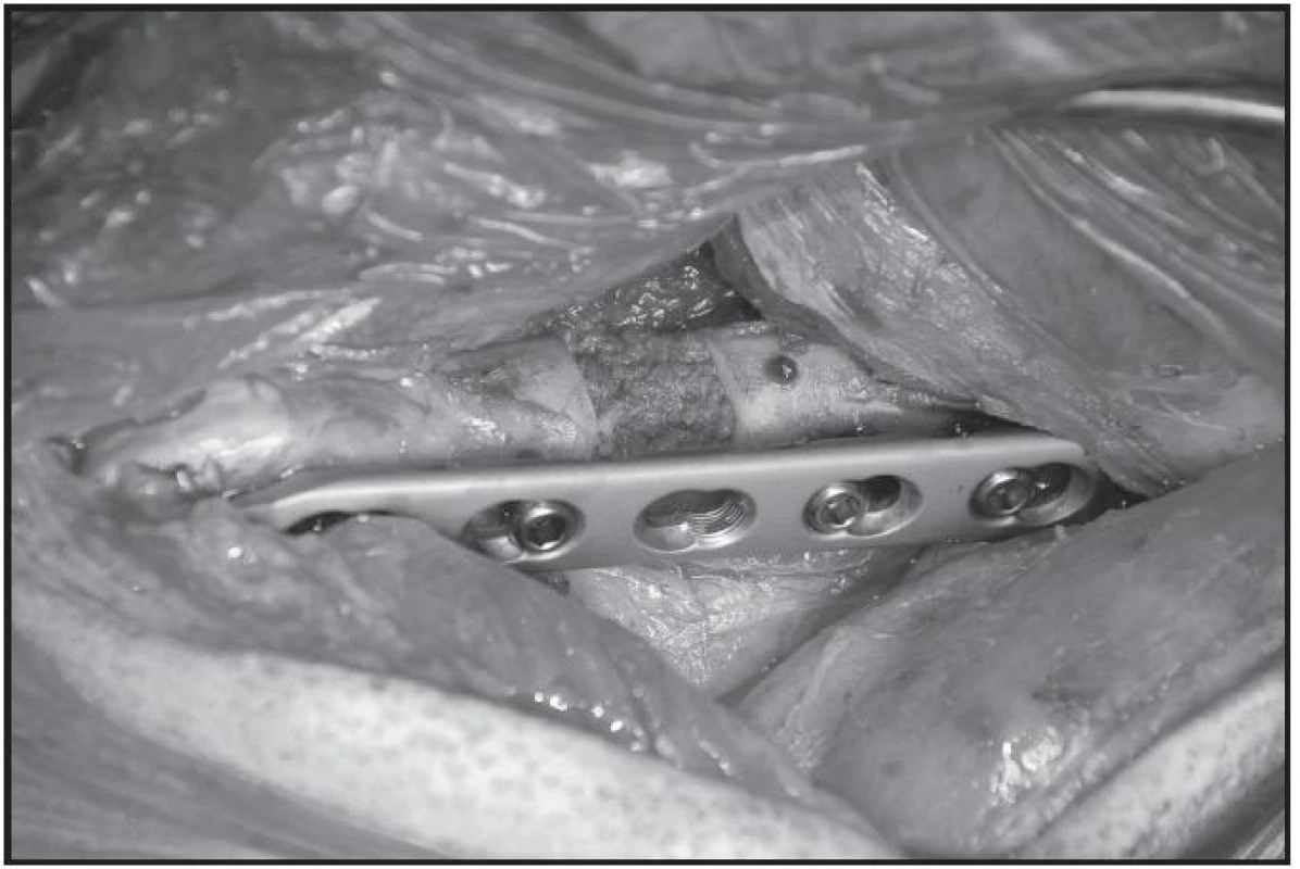 Femorální defekt s náhradou autospongioplastikou (fixace LCP dlaha a Kirschnerův drát)