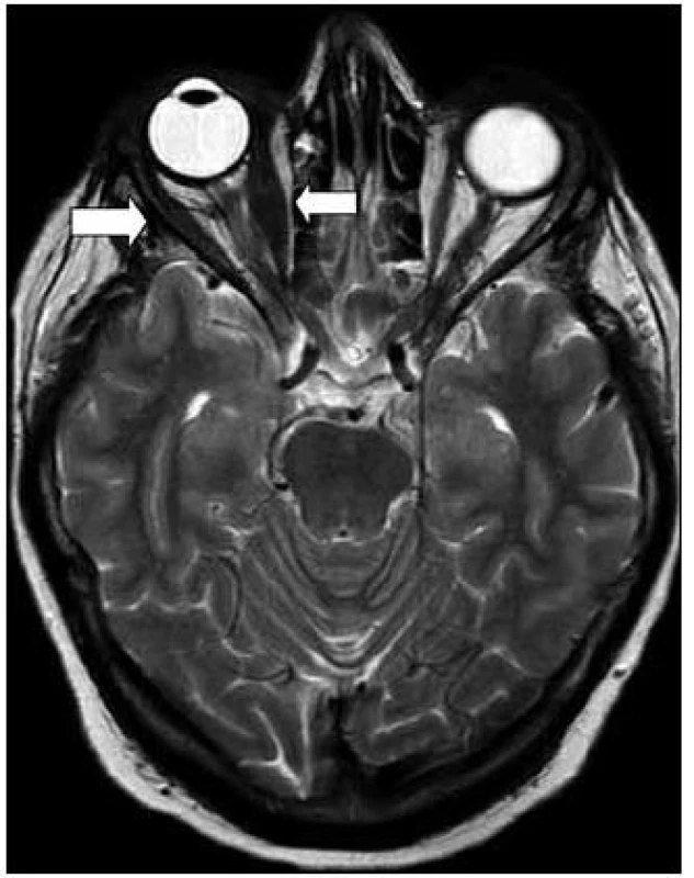 MR zobrazení hlavy. T2 TSE sekvence: zesílení vnitřního a zevního přímého očního svalu vpravo, jejich signál je lehce snížen oproti druhostranným.